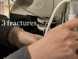 "세 군데 골절" 최가온 직접 밝혔다, 도대체 어떻게 금메달 땄나 [밀라노 올림픽]