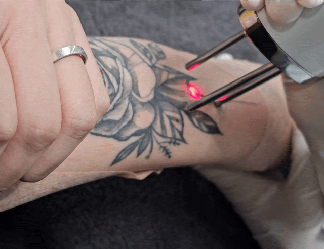 송씨 병원에서 '사랑의 지우개' 사업에 참여한 한 여성 청소년이 새긴 장미 모양의 문신을 레이저로 지우는 모습. /영상제공=송병한씨.