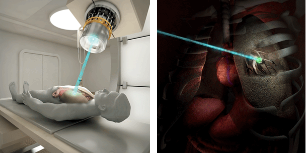 양성자치료 이미지. /사진=국립암센터