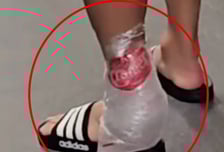 이래놓고 항의를 해? 손흥민, 아킬레스건 직격→얼음 대고 절뚝절뚝..."발에 자국 남아있더라" 위험한 태클에 부상 우려