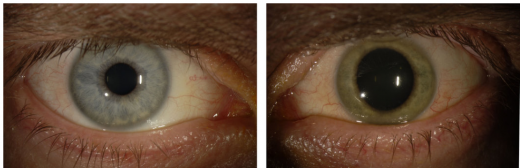 왼쪽 사진은 이안크로지어 씨의 에볼라 바이러스 발생 전 푸른색 눈이고, 오른쪽 사진은 에볼라 바이러스 발생 후 초록색으로 변한 눈이다. /사진=미국 NYT 홈페이지 캡처