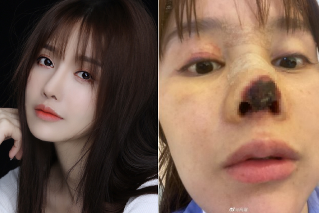 코수술비용 책임감을 가진후 7
