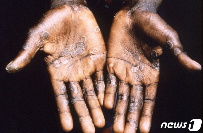 원숭이두창에 감염된 환자의 손. 곳곳에 물집이 잡혀있다. © 로이터=뉴스1 © News1 박형기 기자